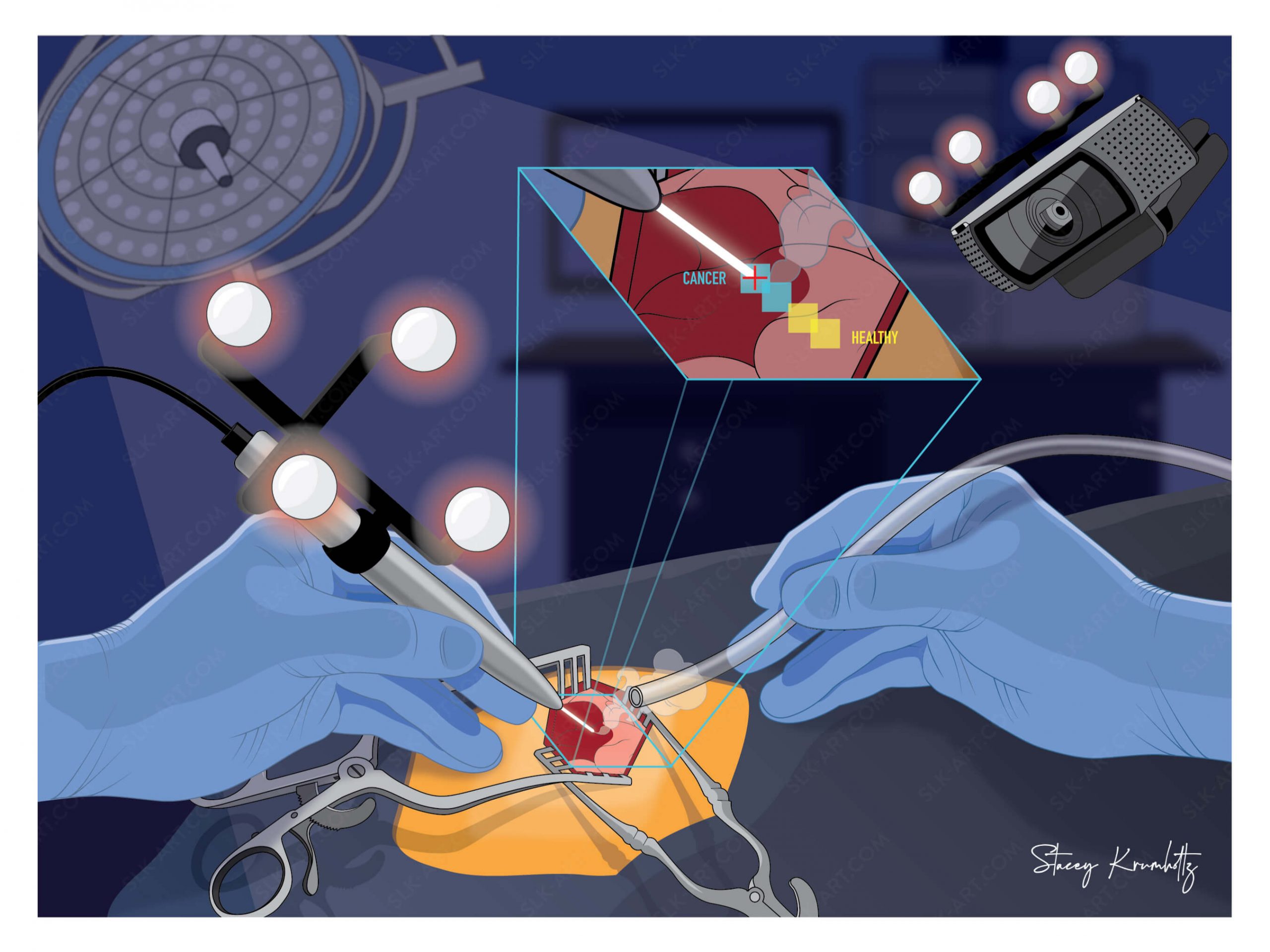 An illustration of a surgical procedure by Stacey Krumholtz.