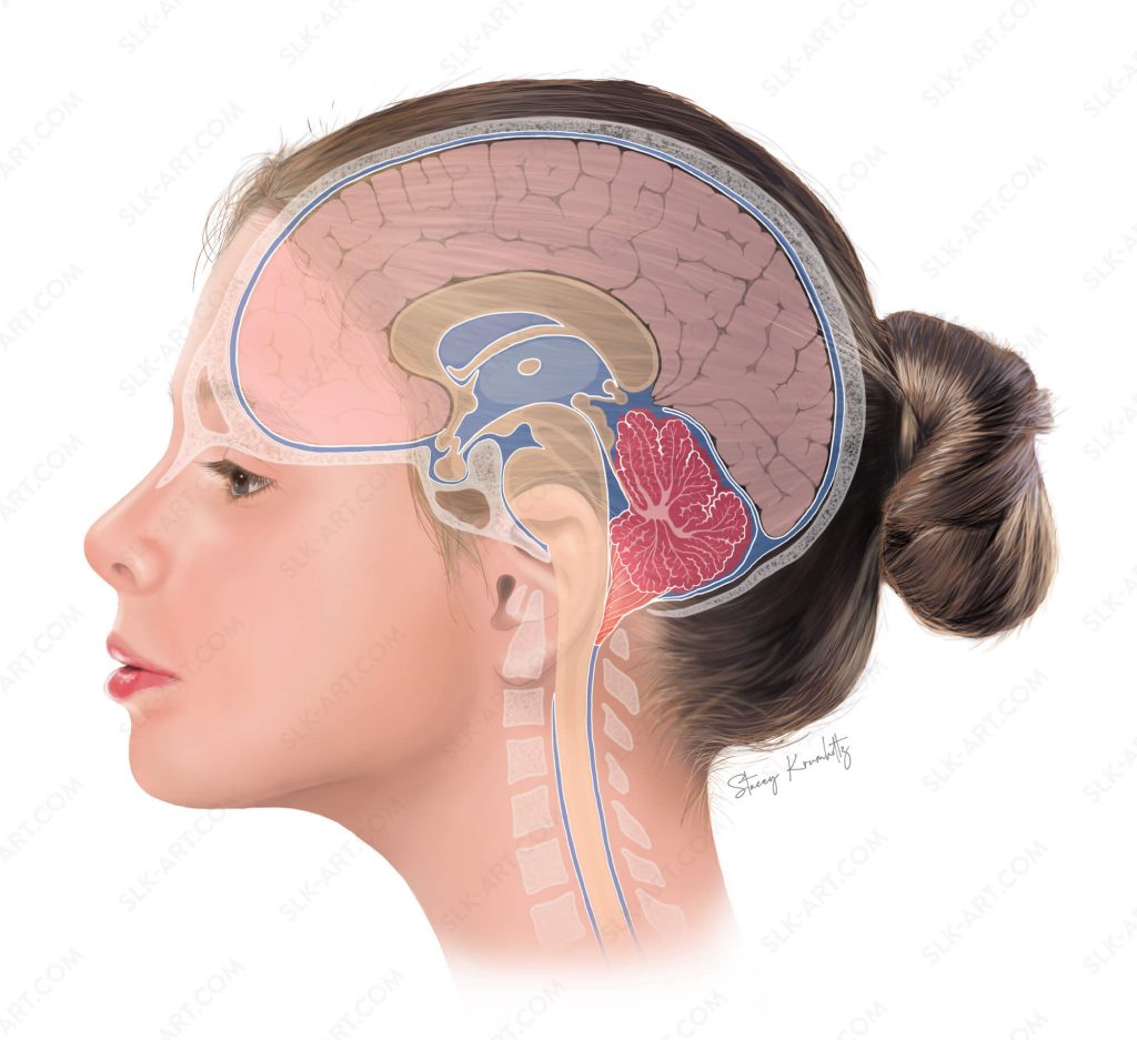 An illustration of Chiari malformations (structural defects in the base of the skull and cerebellum) by Stacey Krumholtz.