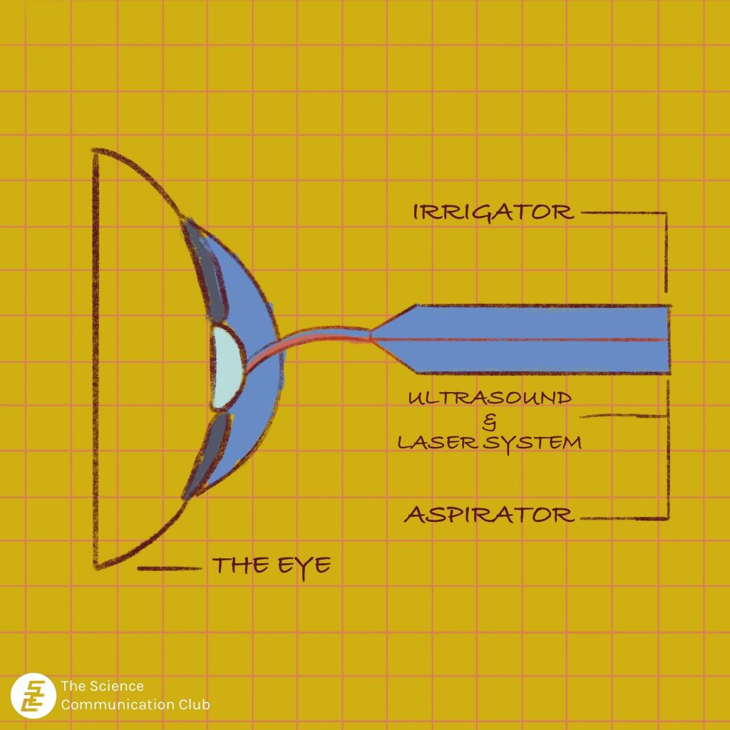 Diagram of a laserphaco probe, with lines indicating the irrigator, combination of ultrasound and laser system, and the aspirator.